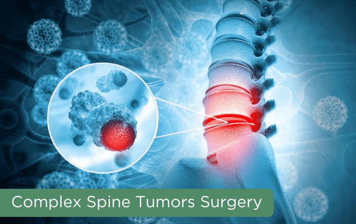 Complex Spine Tumor Surgery in Mumbai, Thane | Dr. Harshal Agrawal