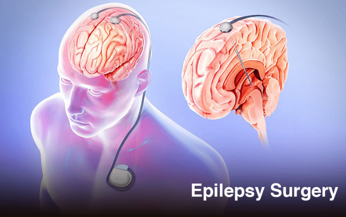 Surgical Treatment Options for Epilepsy