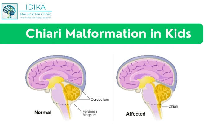 Chiari Malformation in Kids: A Guide for Parents
