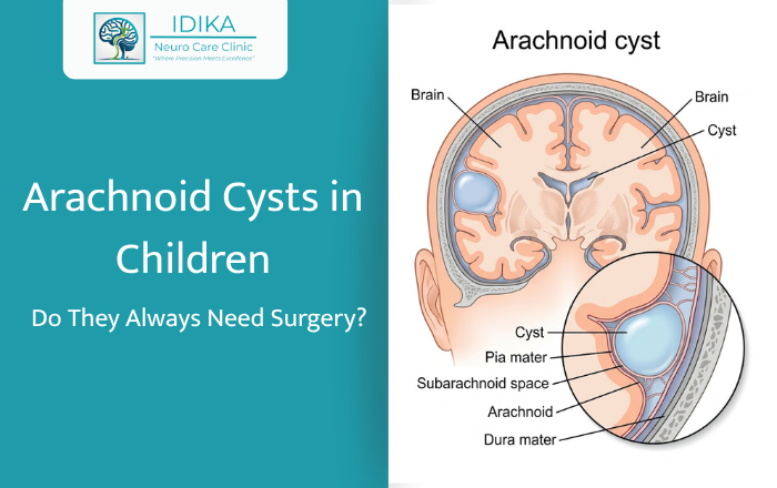Arachnoid Cysts in Children: Do They Always Need Surgery?